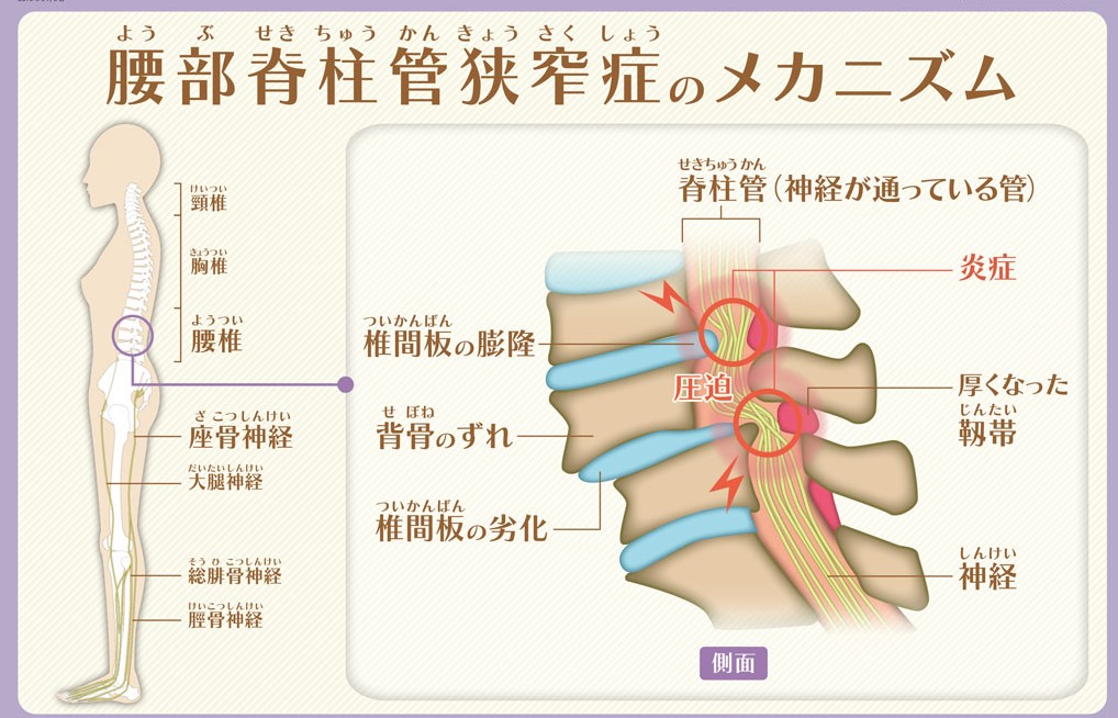 売れ筋】 【珍品】天城流湯治法 手術後後遺症施術 （脊柱管狭窄症・左 